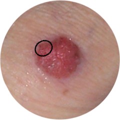 acanthome à cellules claires : repérage de la biopsie