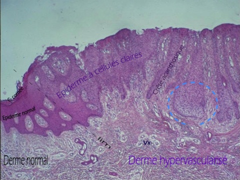 acanthome à cellules claires vu au microscope en faible grossissement. Cliquer sur l'image pour agrandir le cercle bleu