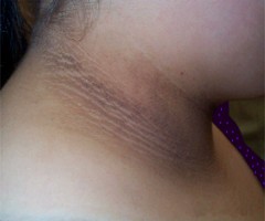 acanthosis nigricans du cou acanthosis nigricans du cou