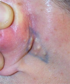 Micro-kystes r�tro-auriculaires