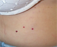 Angiome rubis multiples de l'abdomen