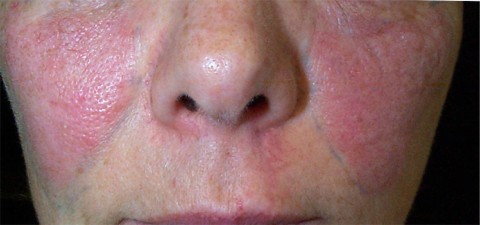 Aspect du visage apr�s LASER vasculaire KTP