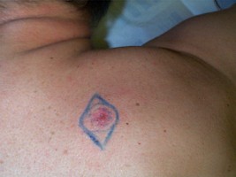 Baso de l'�paule : Dessin de l'ex�r�se avec marge de 4 mm
