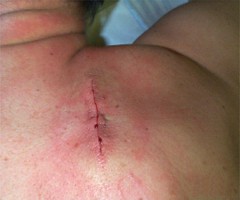 Ex�r�se d'un baso scapulaire: vue post op�ratoire