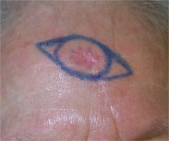 Carcinome baso cellulaire du front dessin de l'exérèse à 4 mm