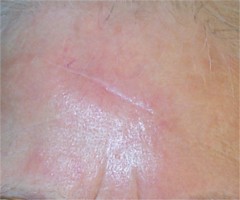 Carcinome baso cellulaire du front r�sultat � 6 mois