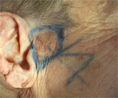 Carcinome baso-cellulaire infiltrant : lambeau d'échange en "L"