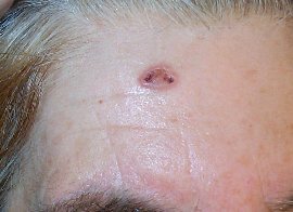 Carcinome baso-cellulaire du front