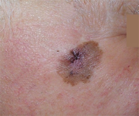 M�lanome de Dubreuilh