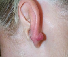 ch�lo�de de l'oreille apr�s per�age du lobule
