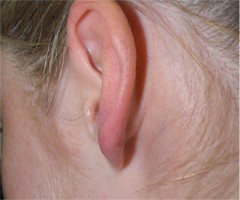 ch�lo�de du lobule op�r�e