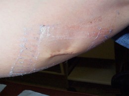 suture �versante sur le mollet au d�but