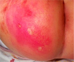 dermite du siege surinfectée à staphyloccoques