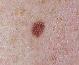 Photo clinique de naevus dermique b�nin