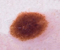 dermoscopie naevus dermique b�nin