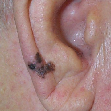 M�lanome de Dubreuilh de l'oreille