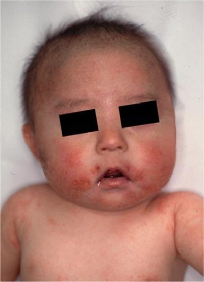 Ecz�ma du visage