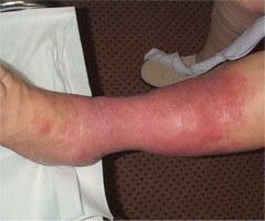 Erysip�le de la jambe