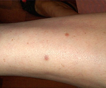 Histiocytofibromes multiples pigmentés