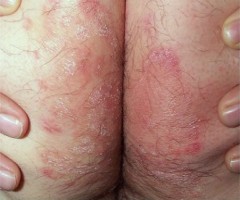 intertrigo des fesses � T rubrum