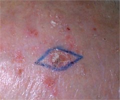 keratoses actiniques du crâne