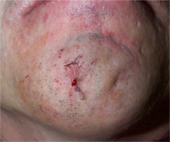 Kyste menton apr�s suture