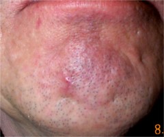 kyste du menton : cicatrice 1 mois apr�s intervention
