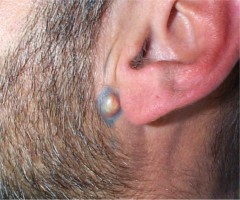 Kyste s�bac� pr�auriculaire
