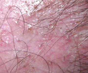 Lichen plan du cuir chevelu : vue macroscopique de l'hyperk�ratose folliculaire