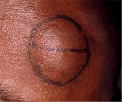 Kyste menton après suture