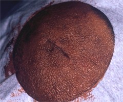 Kyste menton après suture