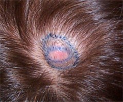 D�placement du cuirchevelu pendant l'intervention