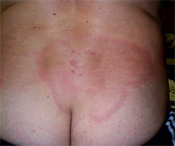 Maladie de Lyme - d�but � la fesse