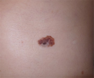 melanome abdomen avec zone gris�tre