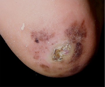 melanome du talon invasif et ulc�r�