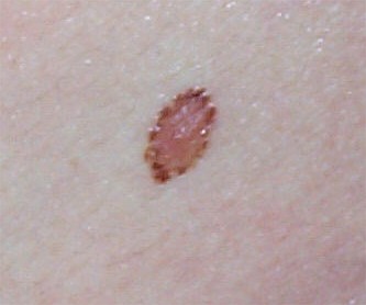 Naevus avec couronne pigment�e p�riph�rique