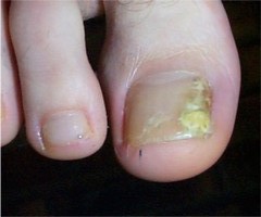 Mycose ungu�ale (onyxis) du gros orteil