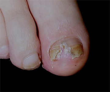 Aspect de l'ongle apr�s pr�l�vement