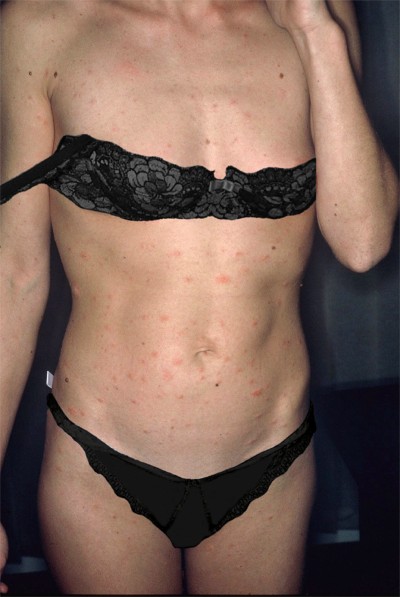 Pityriasis rose de Gibert: r�partition des l�sions