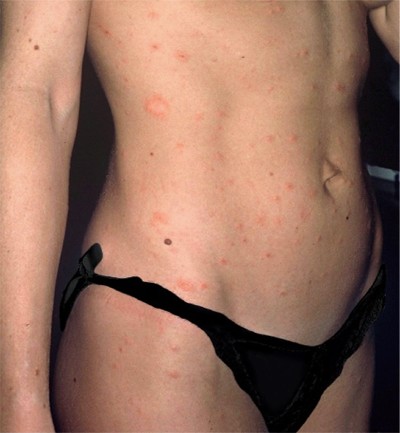 Pityriasis ros� de Gibert : distinguer le m�daillon initial et les l�sions secondaires