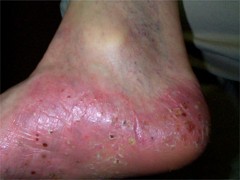 Psoriasis pustuleux : Pustules récentes jaunâtres et pustules anciennes marron