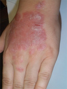Psoriasis �ryth�mateux du dos de la main
