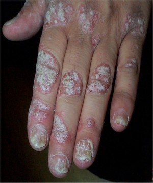 Psoriasis k�ratosique de la main