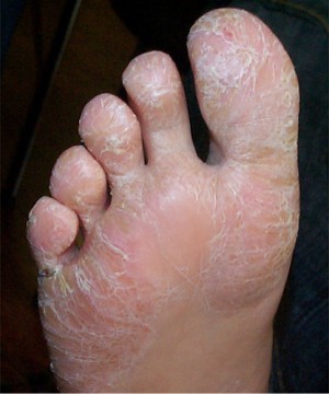 Psoriasis plantaire k�ratosique chez un enfant