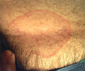 Psoriasis des plis