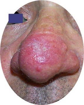 Rosac�e rhinophyma du nez