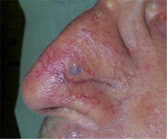 carcinome de l'aile du nez : Rep�rage et biopsie