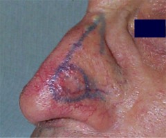 Carcinome du nez : dessin de l'ex�r�se et du lambeau sail-flap