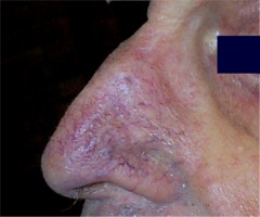 Lambeau du nez : Cicatrice � 8 mois