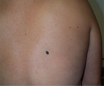 M�lanome SSM �pais de 0,8 mm d�velopp� sur naevus du dos
